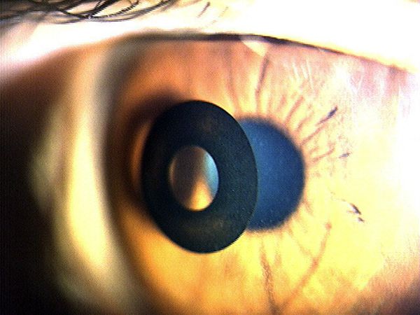 直径３．８ミリのリングを片目の角膜に挿入する手術も／（Ｃ）日刊ゲンダイ
