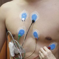 若い人にも起こる心臓突然死 心電図検査で予測できる？