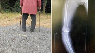 【変形性膝関節症】60歳なのに杖なしで歩けなくなった女性