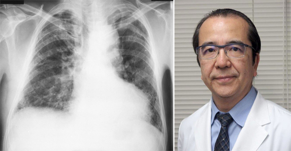 東邦大学医療センター・本間栄教授（写真右）と肺のレントゲン写真