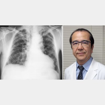 東邦大学医療センター・本間栄教授（写真右）と肺のレントゲン写真