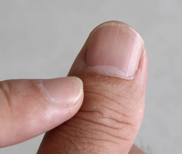 剥がれ 爪 た が 親指 の の 足 爪が剥がれた時の応急処置と伸びるまで過ごし方。何科へ行くべき？