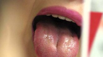 舌が「黄色い人」は糖尿病？有病割合は「白い人」の2.23倍