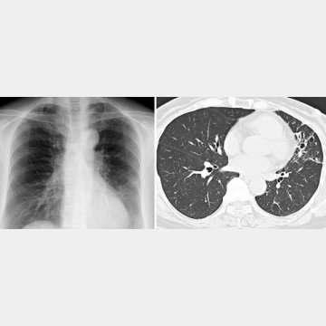 50代女性。胸部X線写真（左）では見落とされやすいが、CT（右）では明らか