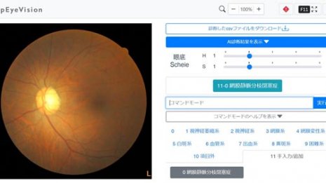 AIが眼底画像診断を支援 糖尿病網膜症や緑内障を発見する