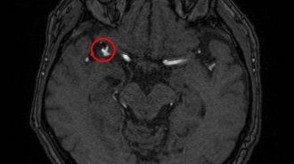 「脳動脈瘤」をスクリーニングするAI画像診断支援ソフトの威力