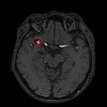 EIRL Brain Aneurysm（エイル・ブレイン・アニュリズム）検出画面