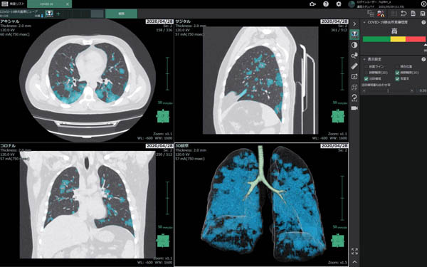 新型コロナ肺炎画像診断支援ソフトウエア 「COVID-19肺炎画像解析プログラム」／富士フイルム提供