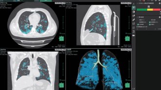 富士フイルムが開発 新型コロナ肺炎の画像診断支援ソフトの実力
