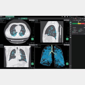 新型コロナ肺炎画像診断支援ソフトウエア 「COVID-19肺炎画像解析プログラム」／富士フイルム提供