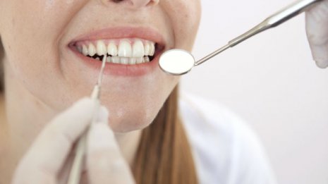 歯周病を悪化させる「歯石」は徹底的に取り除いたほうがいい