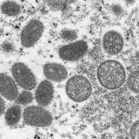 【サル痘】18人感染確認…日本では一般的に広く使える治療薬はない