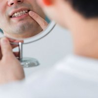 【口腔カンジダ】口の中の常在菌が原因 免疫力の低下をきっかけに発症