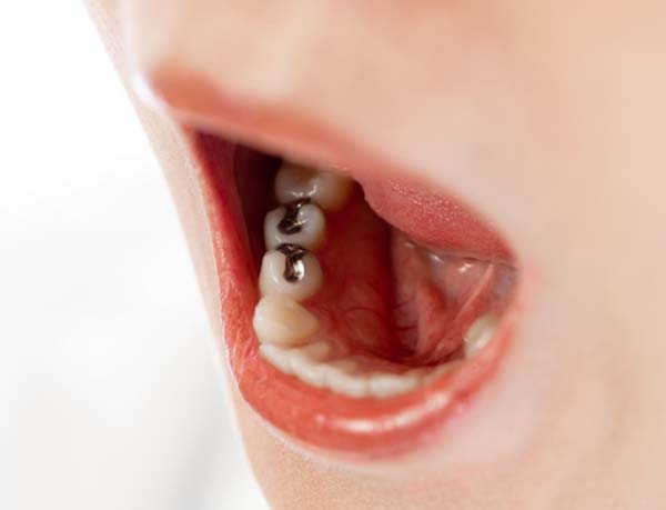 現在でも銀歯は虫歯治療の主流であるが…