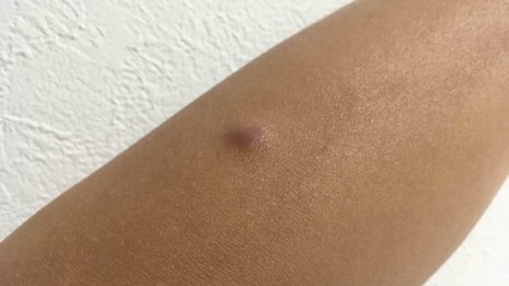 皮膚に現れた「できもの」の正体（1）【皮膚線維腫】蚊に刺されてできた黒く硬いしこりが治らない